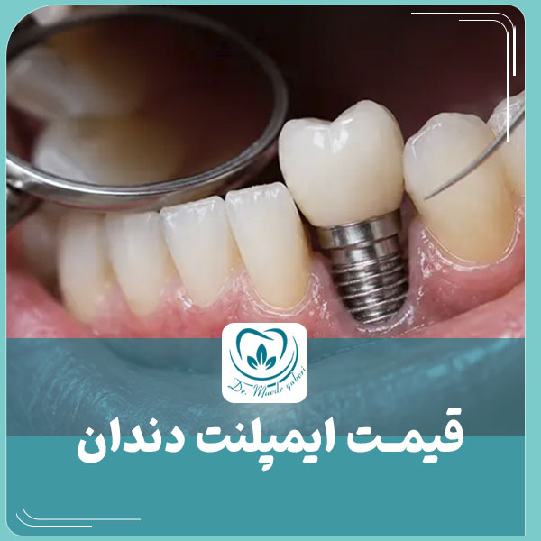 قیمت ایمپلنت دندان