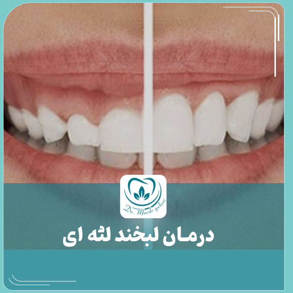 درمان لبخند لثه ای