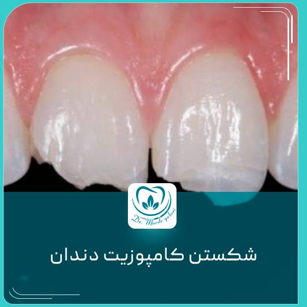 شکستن کامپوزیت دندان