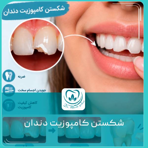 شکستن کامپوزیت دندان