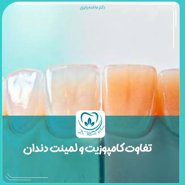 تفاوت کامپوزیت و لمینت دندان