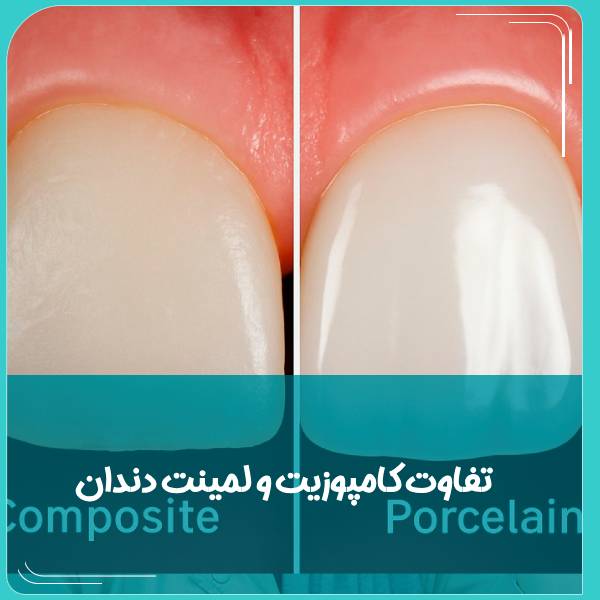 تفاوت کامپوزیت و لمینت دندان