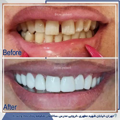 کامپوزیت-دندان-4
